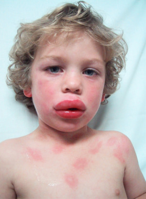 Anaphylactic Reactions are Serious; Potentially Fatal