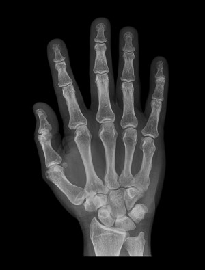 Hand Bones X ray