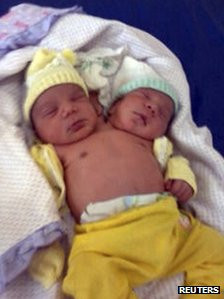 Twins born in Brazil with two heads, one heart