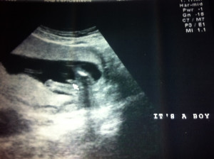14 Weeks Pregnant Ultrasound Boy or Girl