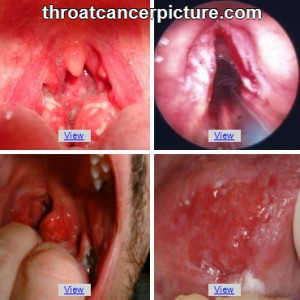 HPV Throat Cancer Symptoms