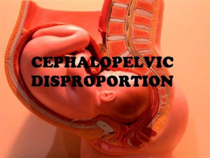 Cephalopelvic Disproportion Diagnosis 142310 633685422951554791 jpg