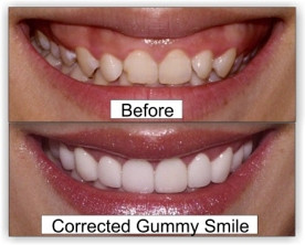 Surgical Muco-Labial Reattachement and Redirect