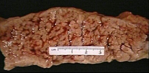 Real Human Pancreas