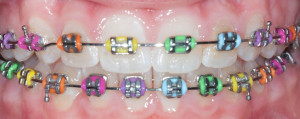 Gentle Braces For Great Smiles