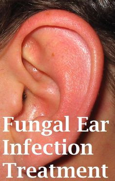 How to Treat Fungal Ear Infections