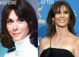 Cher Plastic Surgery Before...