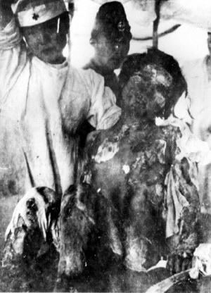 Description Victim of Atomic Bomb of Nagasaki 01.jpg