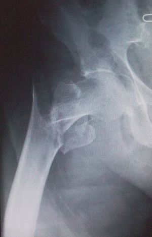 Right extracapsular intertrochanteric fractured neck of femur