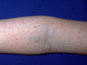 The Rash Rocky Mountain...