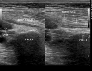 Peroneal Ganglion Cyst Ultrasound