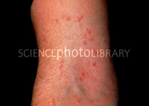 scabies infection