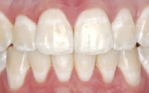 White Spots On Teeth After Braces