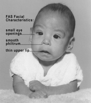 Beskrivelse Photo of baby with FAS.jpg
