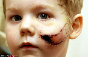 Mauled: Three-year-old Trafford-James Jackson-Poole needed 100 ...