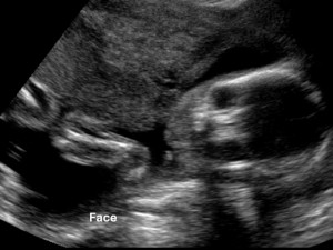 Photograph of Ultrasound scanning of baby face