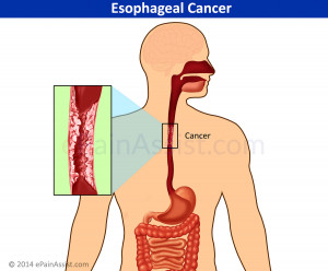 Esophageal Cancer Symptoms