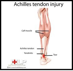 Achilles Tendon Injury