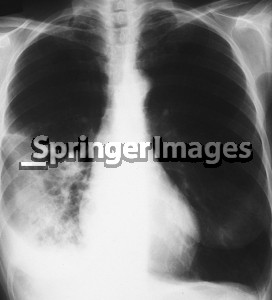 Right Lower Lobe Pneumonia