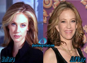ally walker plastic surgery before and after