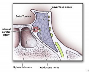 ... sinus showing close proximity to cranial nerves and sphenoid sinus