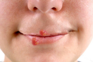 Images Of Shingles Virus On Woman Lips