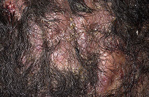 Dissecting Cellulitis The