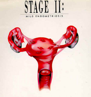 Uterine Cancer Stage 3