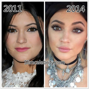 ... Plastic Surgery, Jenner Lips, Cosmetics Surgery, The Jenner, Amazing