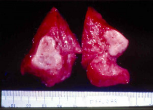 bony lesions in early congenital syphilis