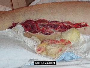 Disgusting Post Leg Surgery...