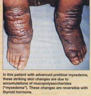 Untreated hypothyroidism can lead to a number of health problems: