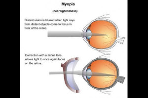 Myopia Picture Slideshow