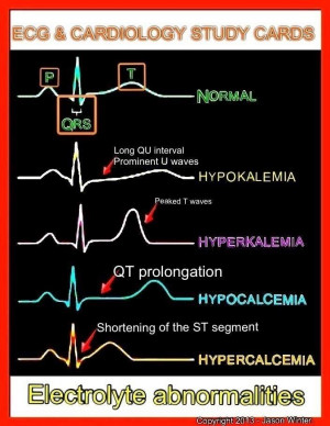 Electrolytes and EKG