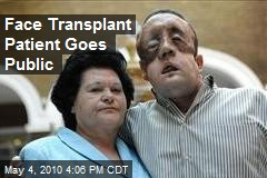 Face Transplant Resilience