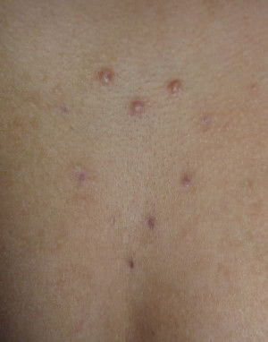 microdermal piercing scars