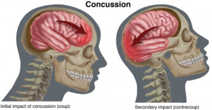Physical Therapist's Guide to Concussion