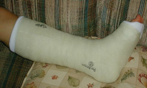 Broken Leg Cast