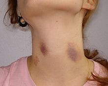 Hickeys on the neck.