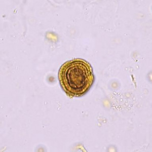 Leucine Crystals Urine Sediment